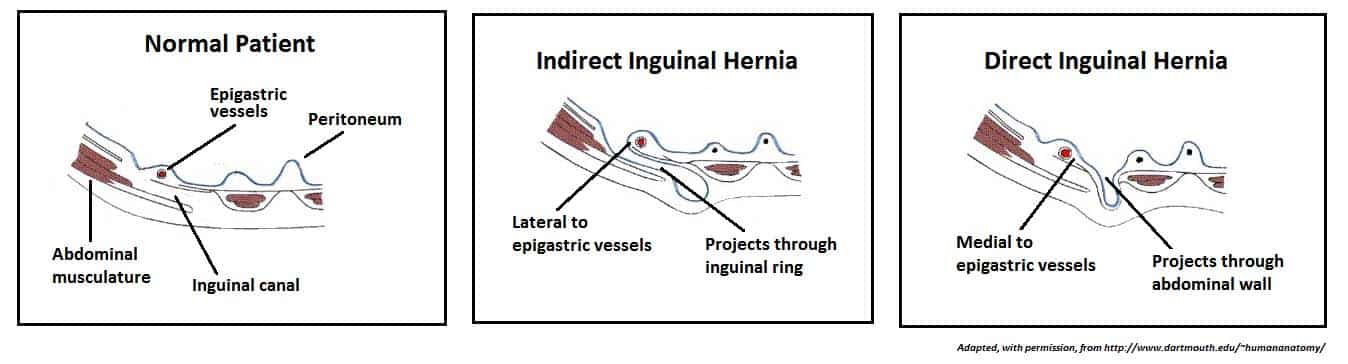 Fig 1.3 - Transverse view of the inferior abdominal cavity. Compares normal anatomy with indirect and direct herniation.
