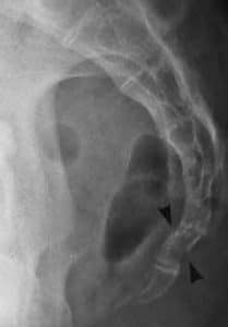 Fig 2- Fractured coccyx demonstrated by the arrows