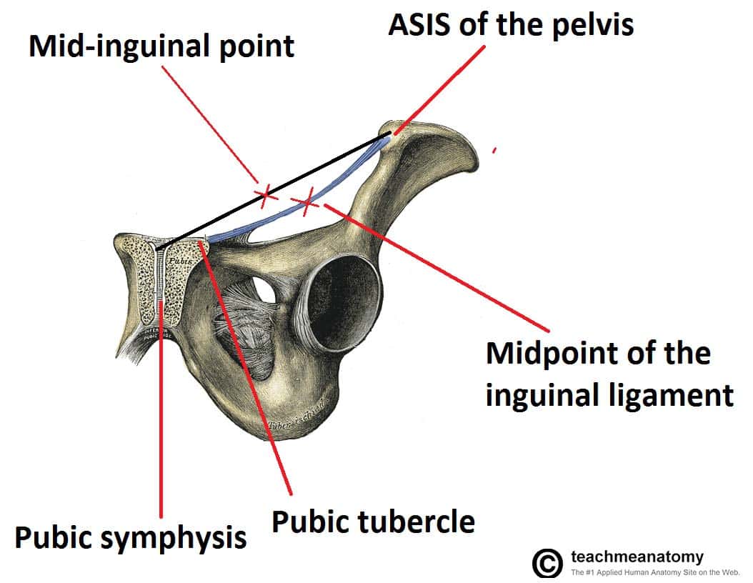 Fig 3 - Coronal view of the pelvis, demonstrating the mid-inguinal point and the midpoint of the inguinal ligament